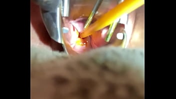 Inserting Foley into cervix